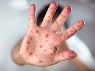 Measles Outbreak in Texas: Measles Cases Rise to 597 Since January 2025, US State on High Alert